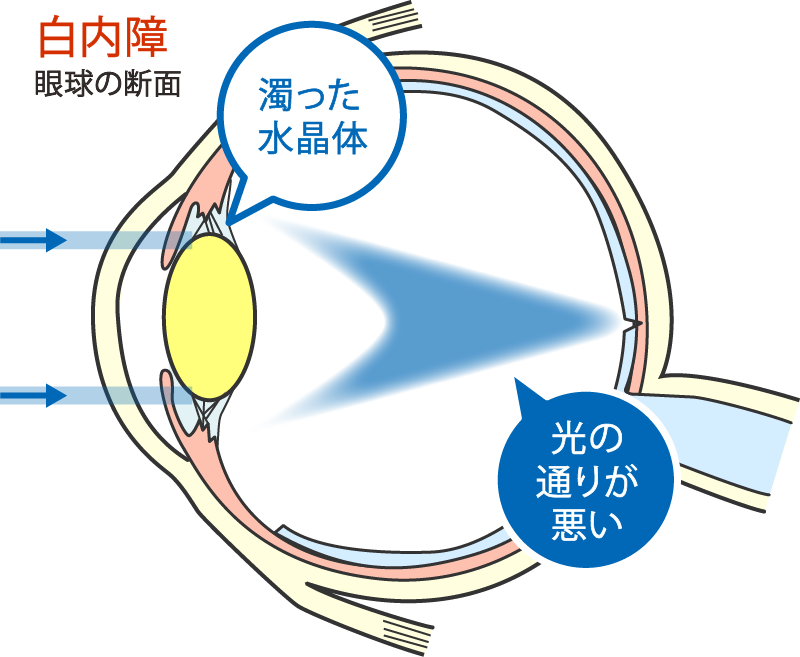 眼球の断面（白内障）