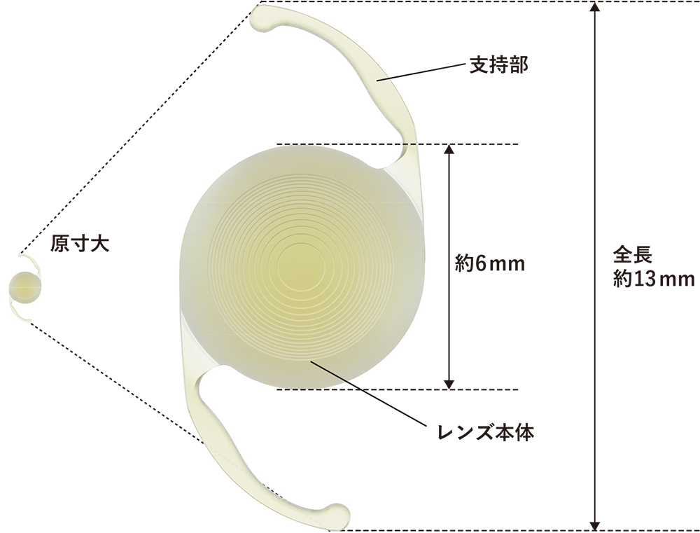 眼内レンズとは？