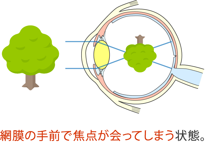 近視