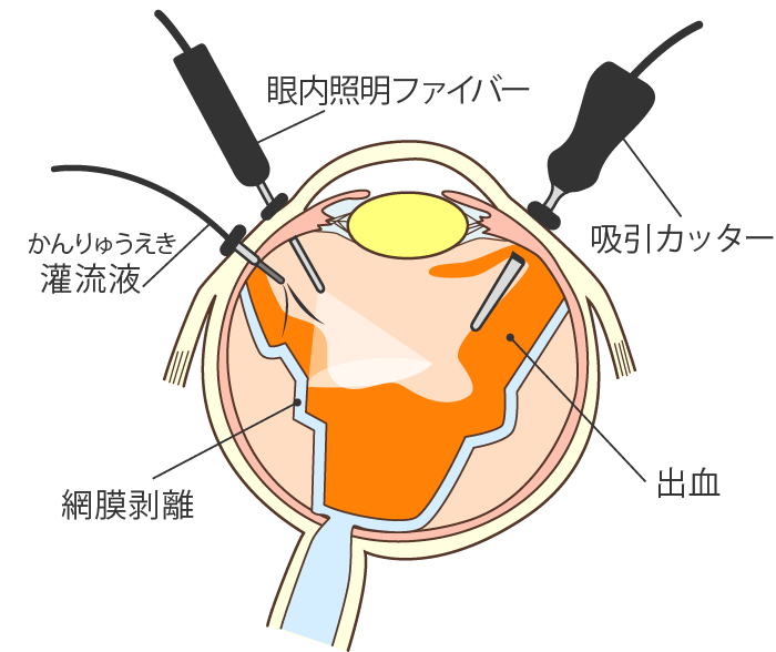 硝子体手術
