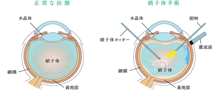 硝子体手術の流れ