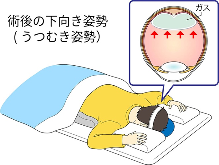 術後安静について
