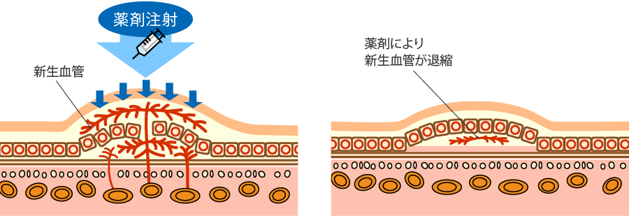 硝子体注射とは